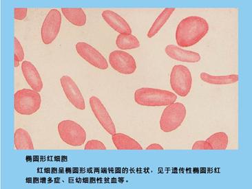 检验主管技师辅导红细胞形态异常2